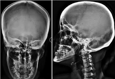 SKULL AP/LAT